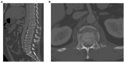 Case report: Continuous spinal cord physiologic monitoring following traumatic spinal cord injury—A report from the Winnipeg Intraspinal Pressure Study (WISP)